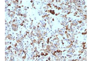 Formalin-fixed, paraffin-embedded human Melanoma stained with MITF Mouse Monoclonal Antibody (MITF/915). (MITF Antikörper)