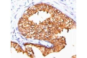 IHC testing of FFPE human prostate carcinoma and ODC antibody (ORN255-1). (ODC1 Antikörper)
