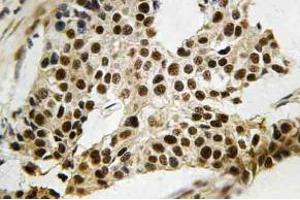 Immunohistochemistry (IHC) analyzes of MAPKAPK-2 antibody in paraffin-embedded human breast carcinoma tissue. (MAPKAP Kinase 2 Antikörper)