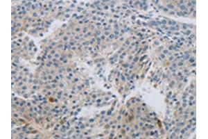 The image on the left is immunohistochemistry of paraffin-embedded Human liver cancer tissue using ABIN7191430(MCMBP Antibody) at dilution 1/60, on the right is treated with synthetic peptide. (MCMBP Antikörper)