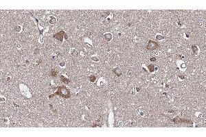 ABIN6277608 at 1/100 staining Human brain cancer tissue by IHC-P. (PSRC1 Antikörper  (Internal Region))