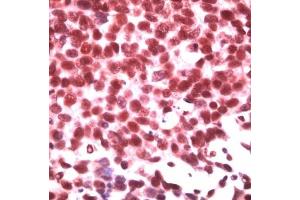 Human breast carcinoma stained with anti-ID3 (ID3 Antikörper  (C-Term))