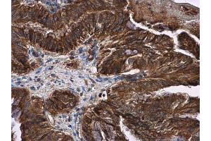 IHC-P Image LOXL2 antibody detects LOXL2 protein at cytoplasm and membrane in human cervical carcinoma by immunohistochemical analysis. (LOXL2 Antikörper)