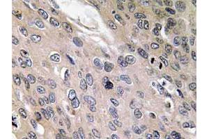 Immunohistochemical analysis of paraffin-embedded human lung cancer tissue using BMP6 polyclonal antibody . (BMP6 Antikörper)