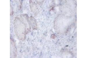 Immunohistochemistry of paraffin-embedded human prostate tissue using ABIN7143582 at dilution of 1:100 (AFG3L2 Antikörper  (AA 550-759))