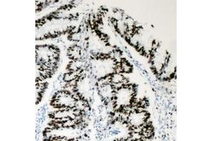 Immunohistochemical analysis of BAF53A staining in human colon cancer formalin fixed paraffin embedded tissue section. (BAF53A Antikörper  (Center))