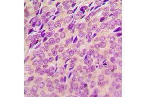 Immunohistochemical analysis of SYK (pY348) staining in human breast cancer formalin fixed paraffin embedded tissue section.