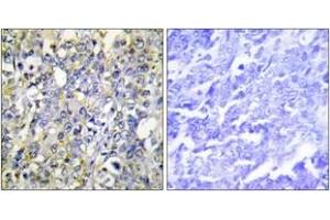 Immunohistochemistry analysis of paraffin-embedded human lung carcinoma tissue, using IGFBP-3 (Ab-183) Antibody. (IGFBP3 Antikörper  (AA 151-200))