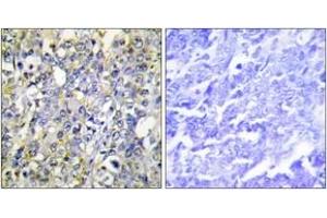Immunohistochemistry analysis of paraffin-embedded human lung carcinoma tissue, using IGFBP-3 (Ab-183) Antibody.