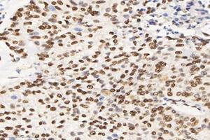 Immunohistochemistry analysis of paraffin-embedded human lung cancer using SET (ABIN7075583) at dilution of 1: 10000 (SET/TAF-I Antikörper)