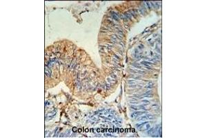HLA-DRA Antibody (N-term) (ABIN390770 and ABIN2841028) IHC analysis in formalin fixed and paraffin embedded human colon carcinoma followed by peroxidase conjugation of the secondary antibody and DAB staining. (HLA-DRA Antikörper  (N-Term))