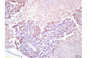 Formalin-fixed and paraffin embedded human lung carcinoma labeled with Anti-FOXM1 Polyclonal Antibody, Unconjugated (ABIN749138) at 1:200 followed by conjugation to the secondary antibody and DAB staining (FOXM1 Antikörper  (AA 301-400))