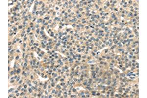 The image on the left is immunohistochemistry of paraffin-embedded Human esophagus cancer tissue using ABIN7192147(RASA2 Antibody) at dilution 1/45, on the right is treated with synthetic peptide.