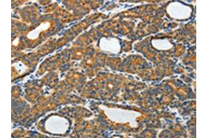 The image on the left is immunohistochemistry of paraffin-embedded Human thyroid cancer tissue using ABIN7130809(RAMP3 Antibody) at dilution 1/40, on the right is treated with fusion protein.