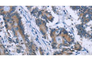Immunohistochemistry of paraffin-embedded Human colon cancer tissue using PLIN1 Polyclonal Antibody at dilution 1:30 (PLIN1 Antikörper)