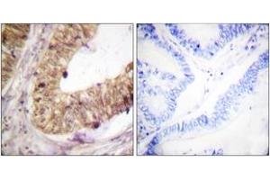 Immunohistochemistry analysis of paraffin-embedded human colon carcinoma tissue, using ATRIP (Ab-68/72) Antibody. (ATRIP Antikörper  (AA 34-83))