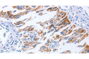 Immunohistochemistry of paraffin-embedded Human lung cancer using KIF3A Polyclonal Antibody at dilution of 1:40 (KIF3A Antikörper)