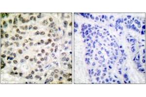 Immunohistochemistry analysis of paraffin-embedded human breast carcinoma tissue, using POLR2A (Ab-1619) Antibody. (POLR2A/RPB1 Antikörper  (AA 1585-1634))