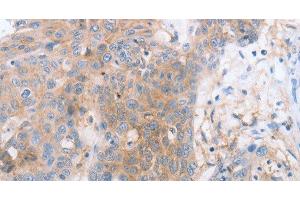 Immunohistochemistry of paraffin-embedded Human esophagus cancer tissue using CD85d Polyclonal Antibody at dilution 1:30 (LILRB2 Antikörper)