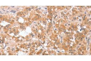 Immunohistochemistry of paraffin-embedded Human thyroid cancer tissue using cPLA2 Polyclonal Antibody at dilution 1:40