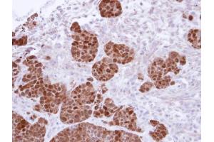 IHC-P Image Immunohistochemical analysis of paraffin-embedded SW480 Xenograft, using S100A11, antibody at 1:500 dilution. (S100A11 Antikörper)