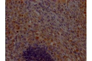 IHC image of ABIN7148184 diluted at 1:200 and staining in paraffin-embedded human ovarian cancer performed on a Leica BondTM system. (CHCHD5 Antikörper  (AA 1-110))