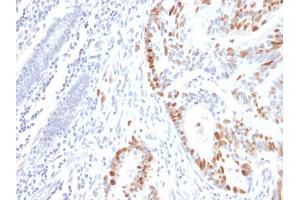 Formalin-fixed, paraffin-embedded human Colon Carcinoma stained with p53 Mouse Recombinant Monoclonal Antibody (rBP53-12). (Rekombinanter p53 Antikörper)