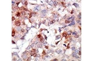 IHC analysis of FFPE human breast carcinoma tissue stained with the AKT3 antibody (AKT3 Antikörper  (AA 88-118))