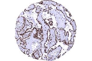 Papillary thyroid cancer with strong nuclear TRIM28 immunostaining of tumor cells (Rekombinanter KAP1 Antikörper  (Center))