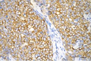 Immunohistochemistry was performed on paraffin-embedded human breast carcinoma using keratin 18 antibody (ABIN7799175), 1:200). (Rekombinanter Cytokeratin 18 Antikörper)