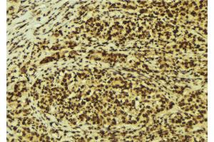 ABIN6274176 at 1/100 staining Human breast cancer tissue by IHC-P. (TCF3 Antikörper  (Internal Region))