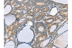 The image on the left is immunohistochemistry of paraffin-embedded Human thyroid cancer tissue using ABIN7192586(SNX29 Antibody) at dilution 1/20, on the right is treated with synthetic peptide. (SNX29 Antikörper)