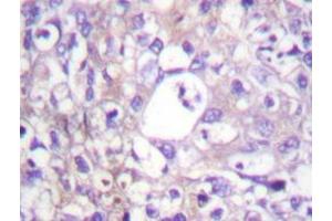 Immunohistochemistry analyzes of SH-PTP2 antibody in paraffin-embedded human breast carcinoma tissue. (PTPN11 Antikörper)