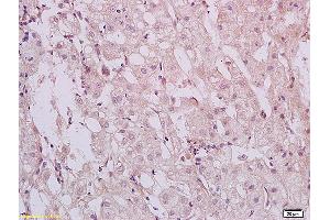 Formalin-fixed and paraffin embedded human hepatitides tissue labeled with Anti HBXIP Polyclonal Antibody,Unconjugated (ABIN873319) at 1:200 followed by conjugation to the secondary antibody and DAB staining. (HBXIP Antikörper  (AA 41-91))