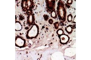 Immunohistochemical analysis of TSHZ2 staining in human prostate cancer formalin fixed paraffin embedded tissue section. (TSHZ2 Antikörper  (C-Term))