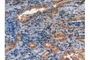 IHC-P analysis of Human Thyroid Cancer Tissue, with DAB staining. (GLA Antikörper  (AA 1-80))