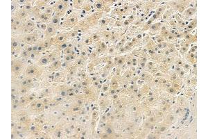 ABIN6262015 and ABIN6279477 at 1/100 staining human gastric carcinoma by IHC-P.
