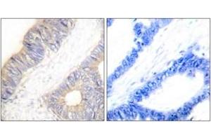 Immunohistochemistry analysis of paraffin-embedded human colon carcinoma tissue, using Stefin A Antibody. (CSTA Antikörper  (AA 49-98))