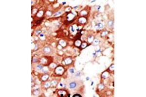 Formalin-fixed and paraffin-embedded human cancer tissue reacted with the primary antibody, which was peroxidase-conjugated to the secondary antibody, followed by DAB staining. (ACSL4 Antikörper  (AA 236-267))