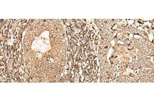 Immunohistochemistry of paraffin-embedded Human esophagus cancer tissue using GALR2 Polyclonal Antibody at dilution of 1:40(x200) (GALR2 Antikörper)