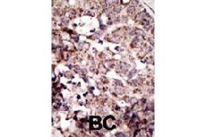 Formalin-fixed and paraffin-embedded human cancer tissue reacted with AGER polyclonal antibody  , which was peroxidase-conjugated to the secondary antibody, followed by AEC staining . (RAGE Antikörper  (N-Term))