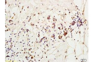 Formalin-fixed and paraffin embedded human breast carcinoma labeled with Anti-MCP-2 Polyclonal Antibody, Unconjugated  at 1:200 followed by conjugation to the secondary antibody and DAB staining (CCL8 Antikörper  (AA 24-99))