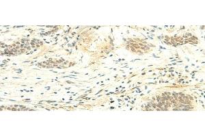 Immunohistochemistry of paraffin-embedded Human esophagus cancer tissue using ATMIN Polyclonal Antibody at dilution of 1:50(x200) (ATM Interactor Antikörper)