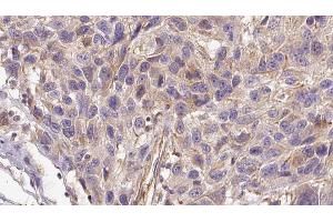 ABIN6272953 at 1/100 staining Human Melanoma tissue by IHC-P. (AGGF1 Antikörper  (Internal Region))