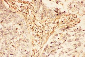 Anti-LIF Picoband antibody,  IHC(P): Human Lung Cancer Tissue (LIF Antikörper  (AA 23-202))