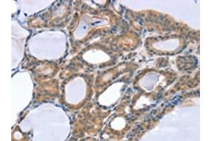 The image on the left is immunohistochemistry of paraffin-embedded Human thyroid cancer tissue using ABIN7131131(SNX4 Antibody) at dilution 1/25, on the right is treated with fusion protein. (Sorting Nexin 4 Antikörper)