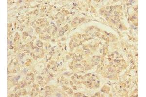Immunohistochemistry of paraffin-embedded human pancreatic cancer using ABIN7167664 at dilution of 1:100 (Relaxin 3 Receptor 1 Antikörper  (AA 1-80))