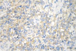 Immunohistochemistry was performed on paraffin-embedded human glioblastoma using huntingtin antibody (ABIN7799005), 1:200). (Rekombinanter Huntingtin Antikörper)