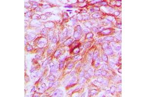 Immunohistochemical analysis of Phospholipase D4 staining in human breast cancer formalin fixed paraffin embedded tissue section.