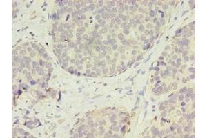 Immunohistochemistry of paraffin-embedded human gastric cancer using ABIN7175400 at dilution of 1:100